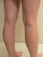 Varicose Veins