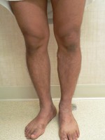 Varicose Veins