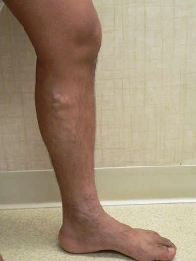 Varicose Veins