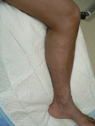 Varicose Veins