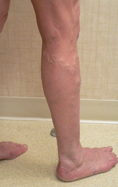 Varicose Veins