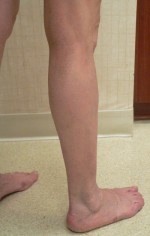 Varicose Veins