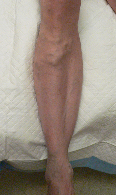 Varicose Veins