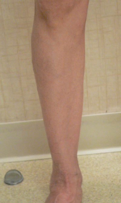 Varicose Veins