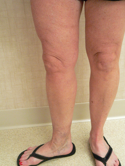 Varicose Veins