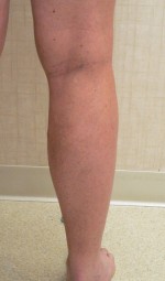 Varicose Veins