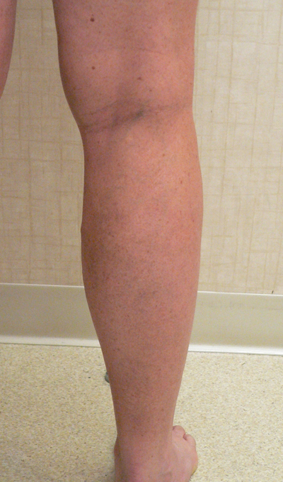 Varicose Veins