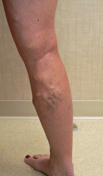 Varicose Veins