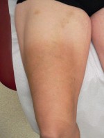 Varicose Veins