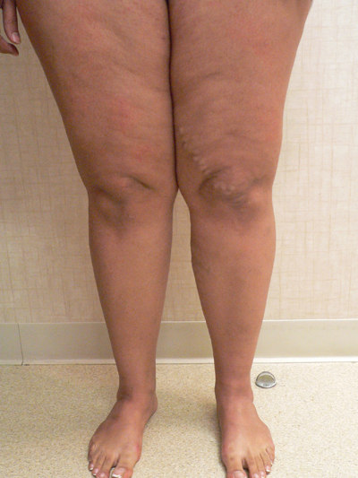 Varicose Veins