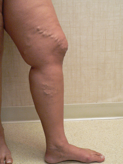 Varicose Veins