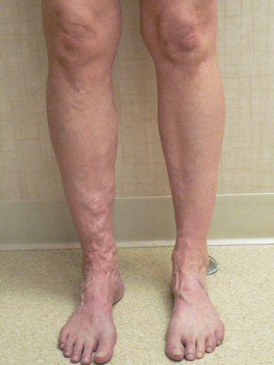 Varicose Veins