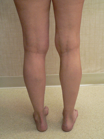 Varicose Veins