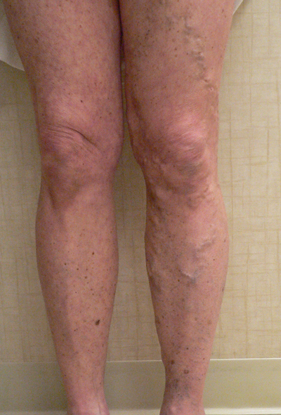 Varicose Veins