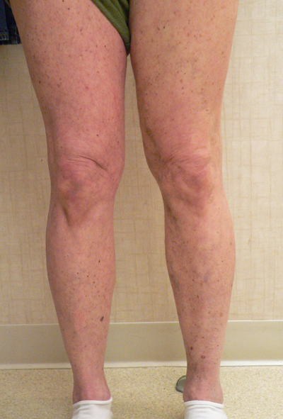 Varicose Veins