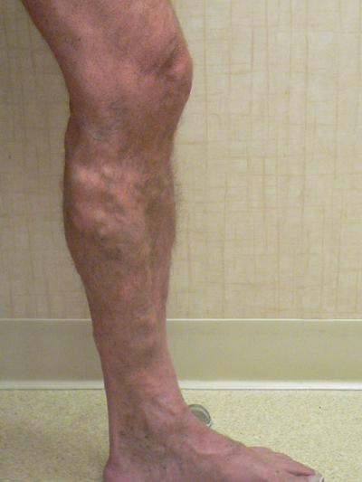 Varicose Veins