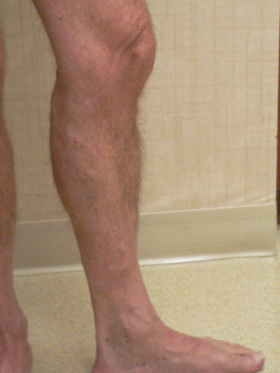 Varicose Veins