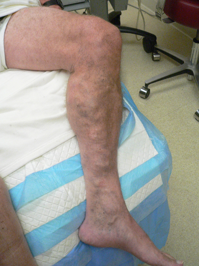 Varicose Veins