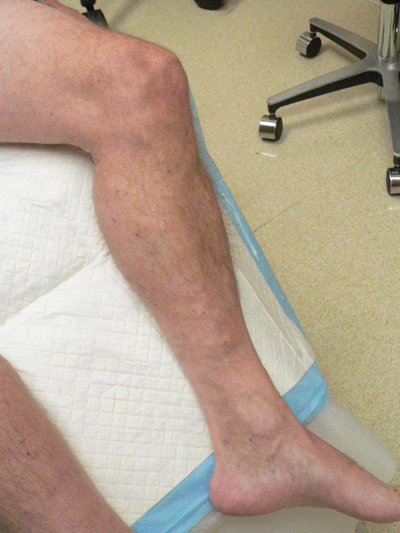 Varicose Veins