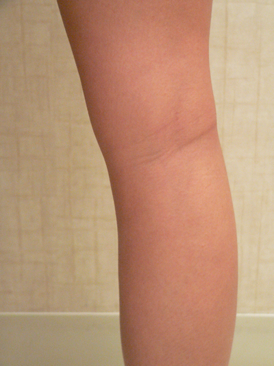 Blue Veins Case 3865 After Photo Blue Veins
