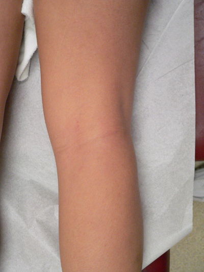 Blue Veins Case 3865 After Photo Blue Veins