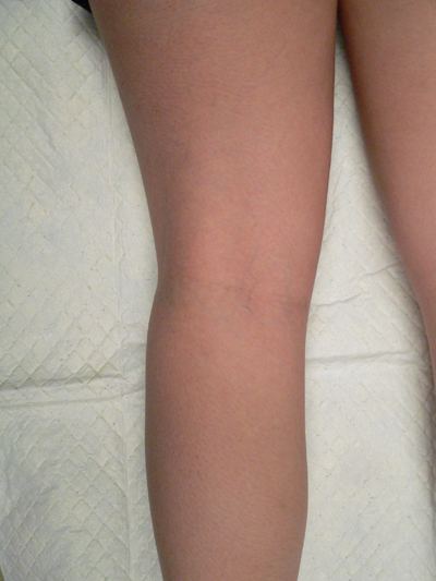 Blue Veins Case 3865 Before Photo Blue Veins