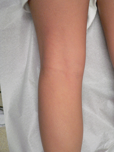 Blue Veins Case 3865 After Photo Blue Veins
