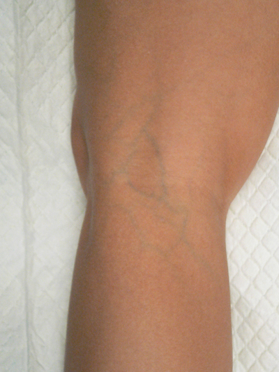 Blue Veins Case 3873 Before Photo Blue Veins