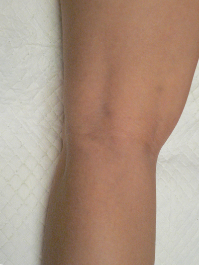 Blue Veins Case 3873 After Photo Blue Veins
