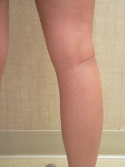 Blue Veins Case 3873 Before Photo Blue Veins