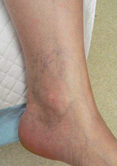 Ankle Veins