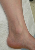 Ankle Veins