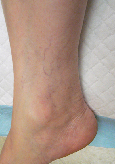 Ankle Veins