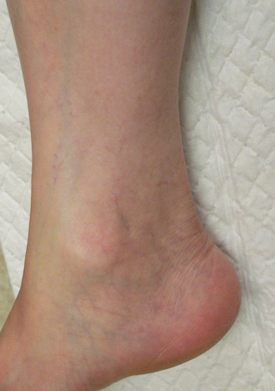 Ankle Veins