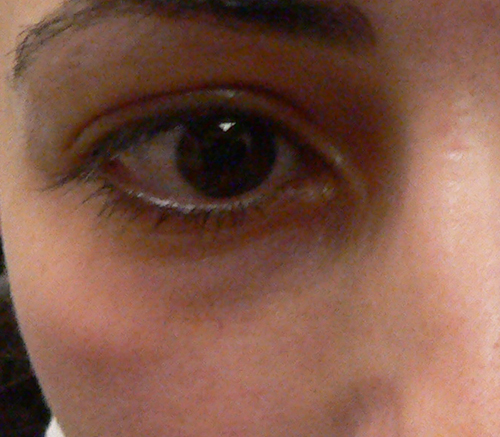 Facial Veins Case 3901 After Photo Facial Veins