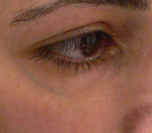 Facial Veins Case 3901 Before Photo Facial Veins