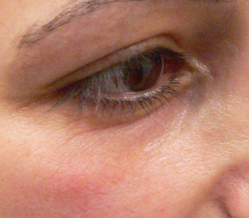 Facial Veins Case 3901 After Photo Facial Veins