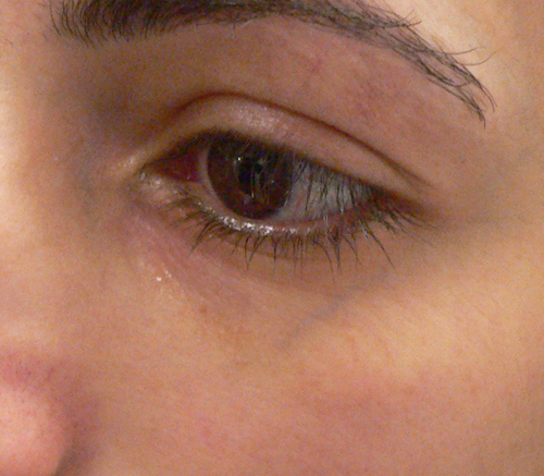 Facial Veins Case 3901 Before Photo Facial Veins