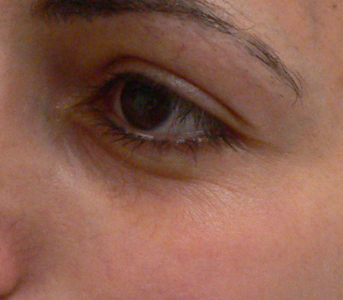 Facial Veins Case 3901 After Photo Facial Veins