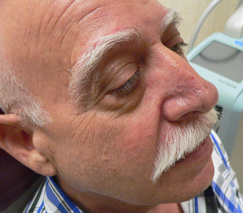 Facial Veins Case 3950 Before Photo Facial Veins