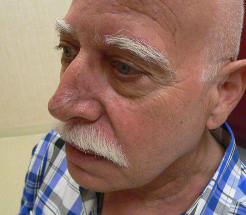 Facial Veins Case 3950 Before Photo Facial Veins
