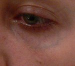 Facial Veins