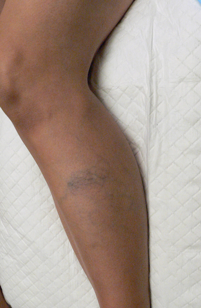 Combination of Leg Vein Treatments