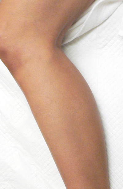 Combination of Leg Vein Treatments