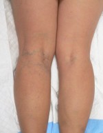 Combination of Leg Vein Treatments