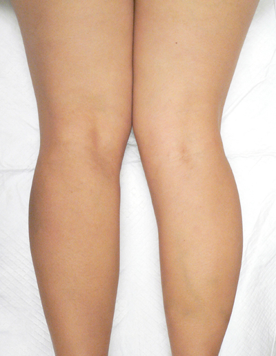 Combination of Leg Vein Treatments