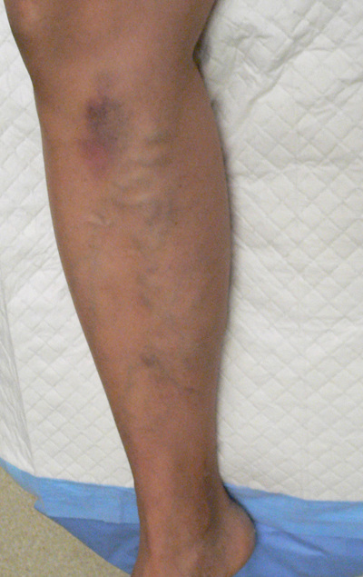 Combination of Leg Vein Treatments