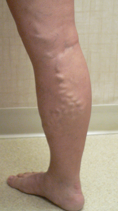 Combination of Leg Vein Treatments