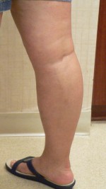 Combination of Leg Vein Treatments