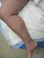 Combination of Leg Vein Treatments